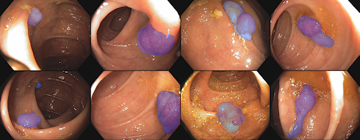 KoloPol – Automatic and Diagnosis-supporting Detection of Polyps in Colonoscopic Image Sequences