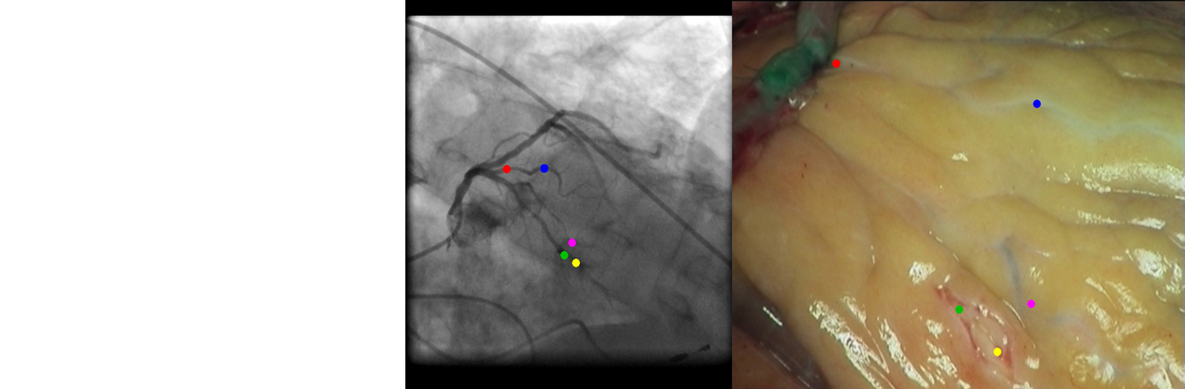 MISS – Interactive Registration and Visualization of Cardiac Video and Angiography