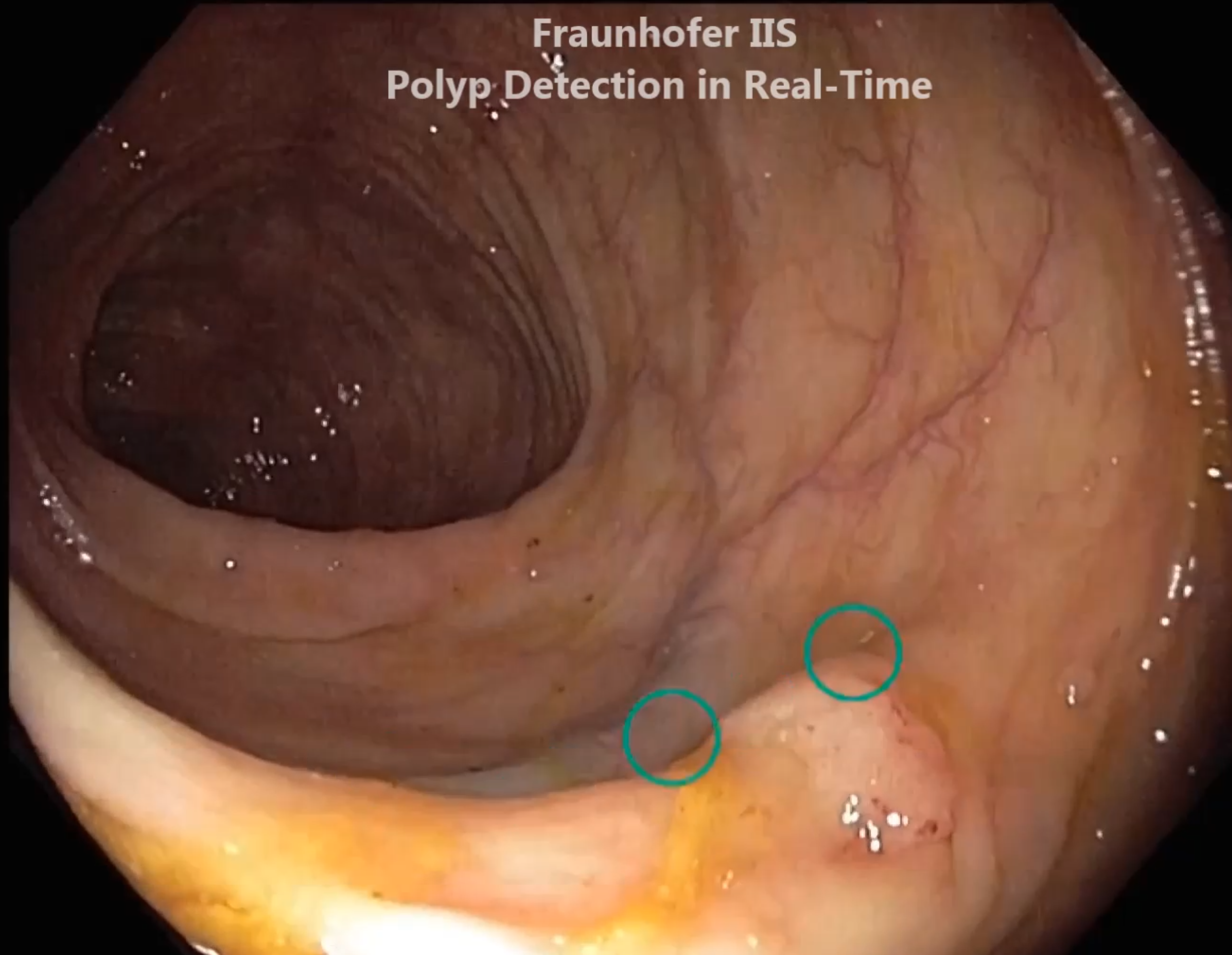 KoloPol recognizes polyps (indicated by the green circle) in real time.